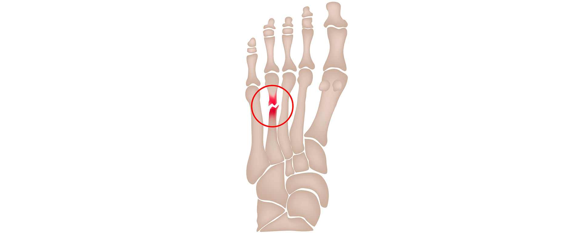 Illustration D'une Fracture De Stress Au Pied - Métatarsien - Dessin Où On Voit Les Métatarses