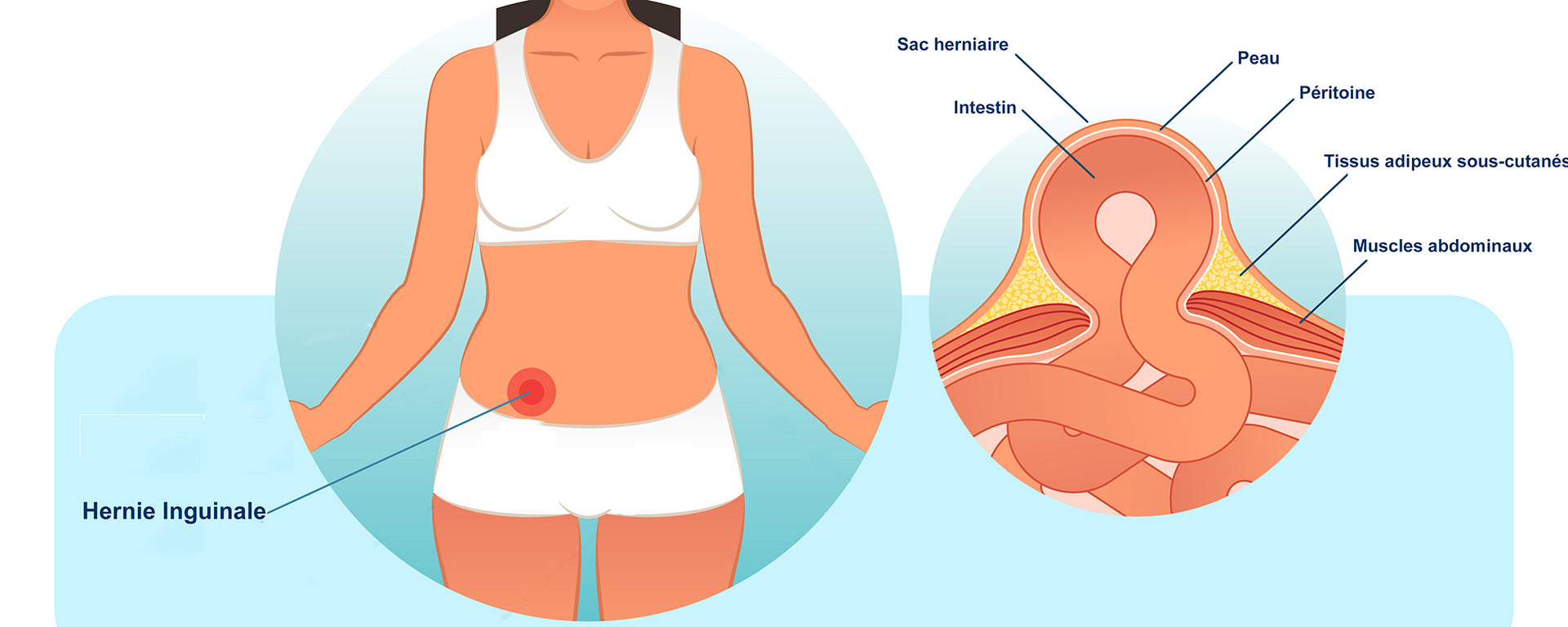 Hernie Inguinale Femme: Illustration Avec Vue Rapprochée Et Explications