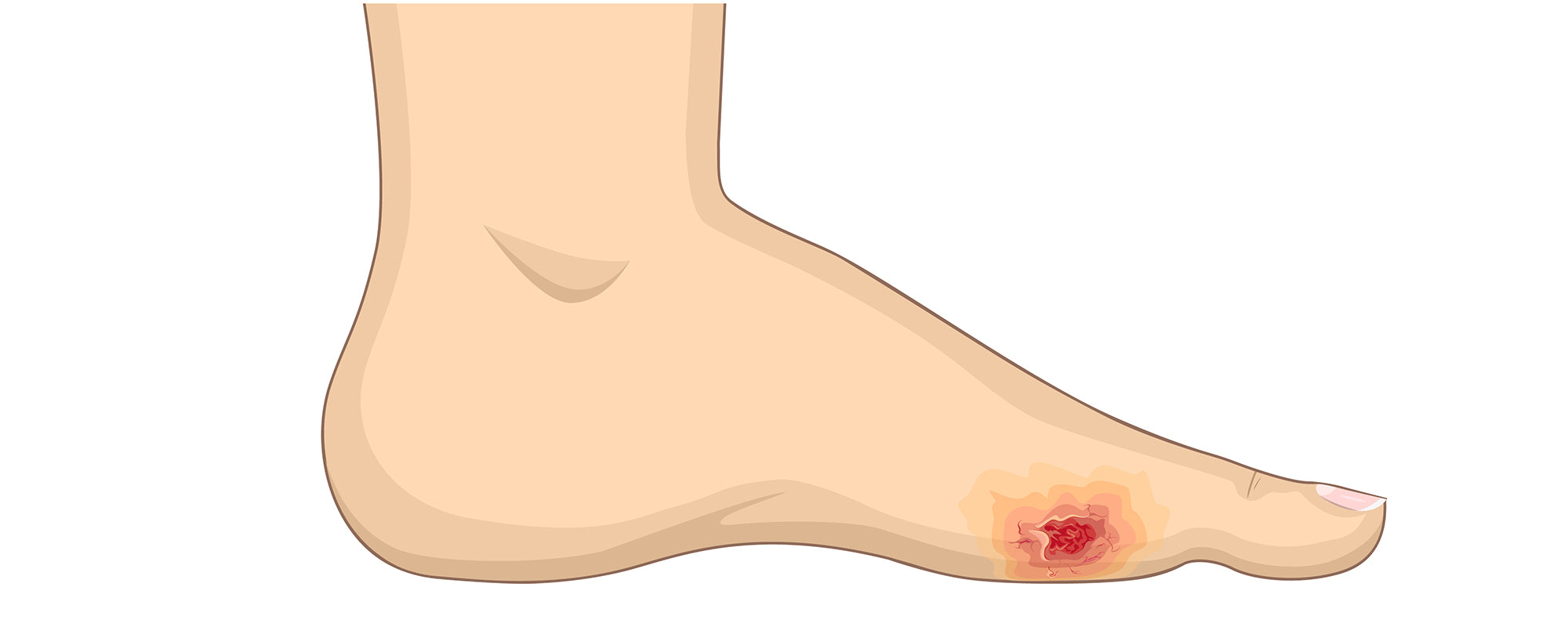 Pied Diab tique Neuropathie D finition Sympt mes Traitement